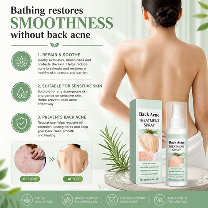 BacneAway™ Skin Spray