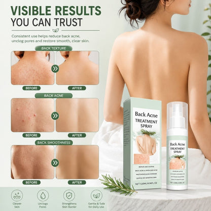 BacneAway™ Skin Spray