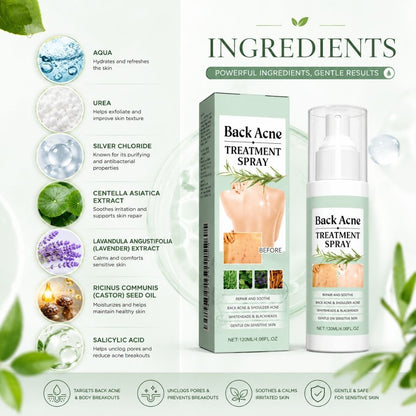 BacneAway™ Skin Spray