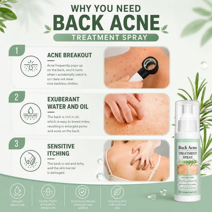 BacneAway™ Skin Spray